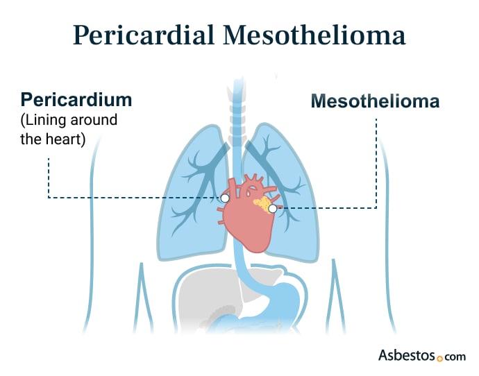 Pericardial Mesothelioma