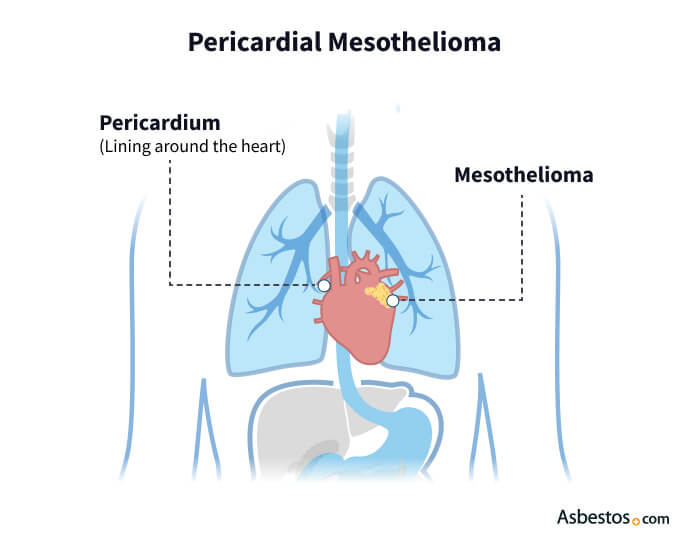 Pericardial Mesothelioma diagram