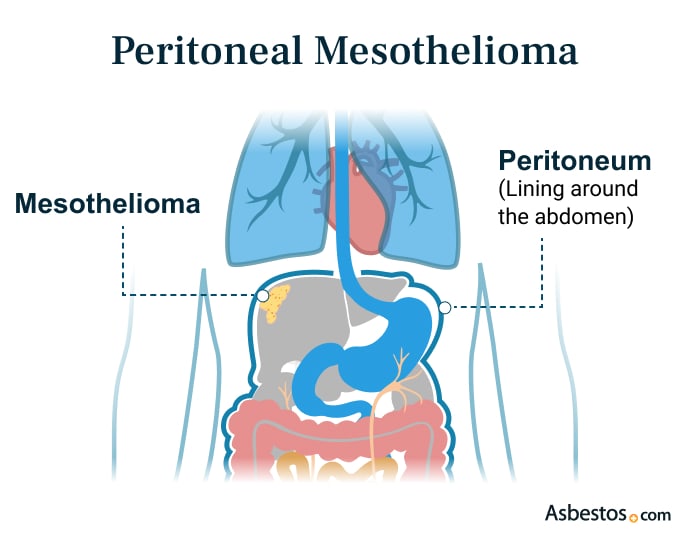 Peritoneal Mesothelioma