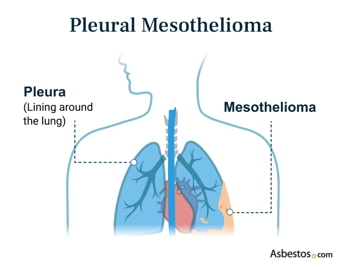 Pleural Mesothelioma
