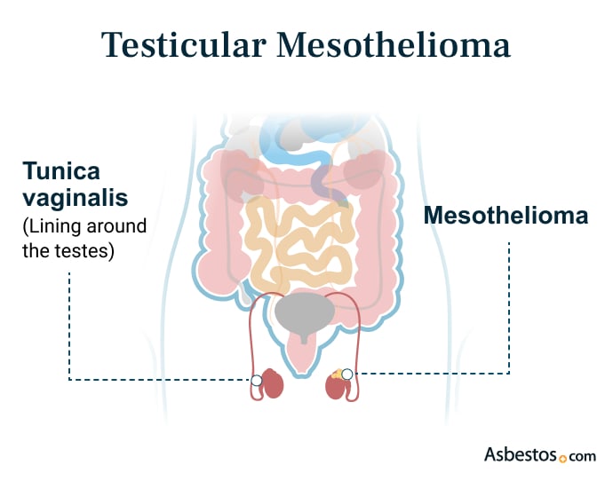 Testicular Mesothelioma