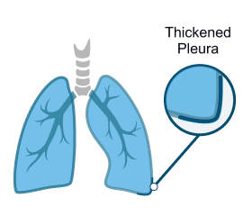 Diffuse Pleural Thickening (Thickened Pleura)
