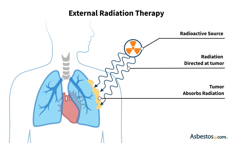 External beam radiation therapy for pleural mesothelioma