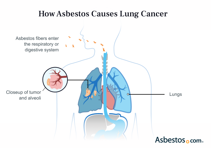 Illustration of How Asbestos Can Cause Lung Cancer