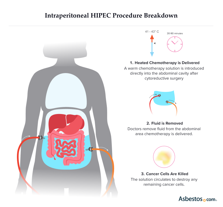 Intraperitoneal HIPEC Procedure Breakdown