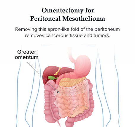 Omentectomy for Peritoneal Mesothelioma Illustration