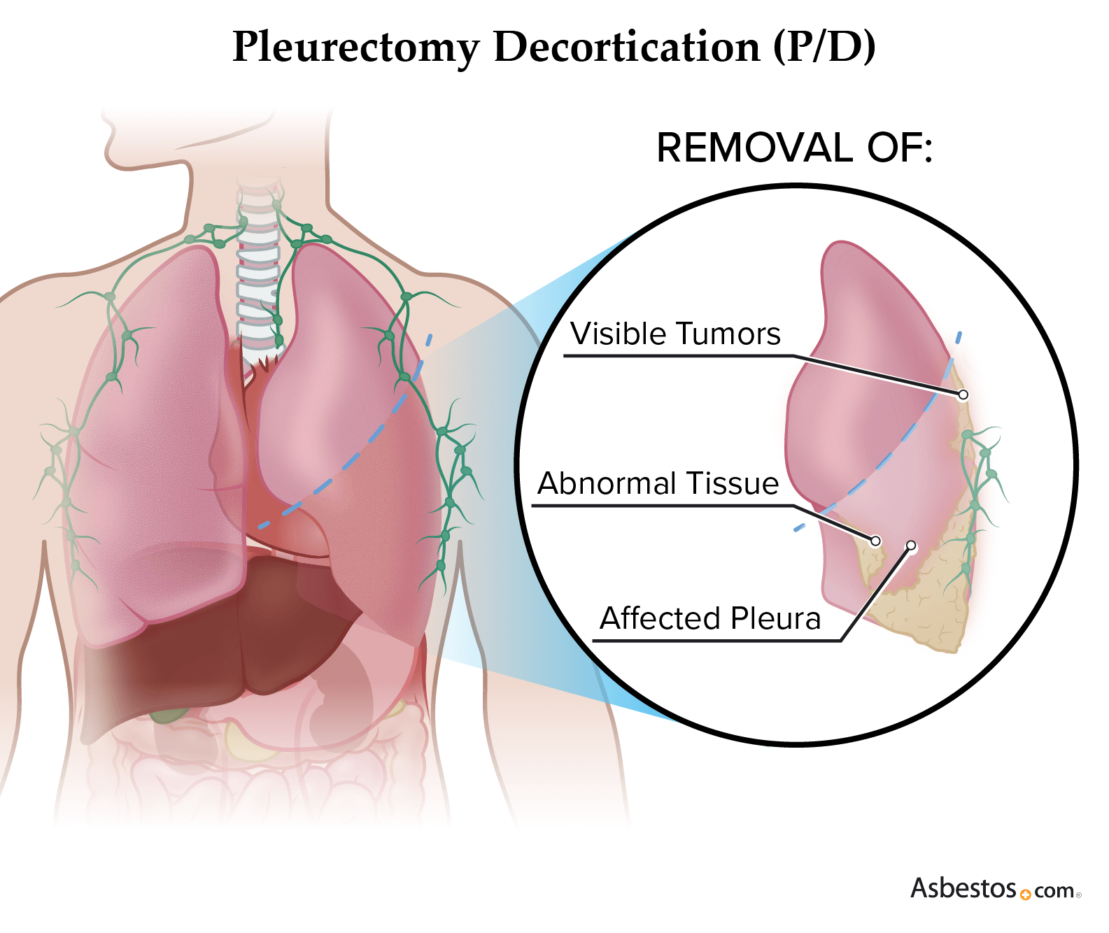 Graphic of pleurectomy/decortication (P/D), showing reserved lung with pleura surgically removed.