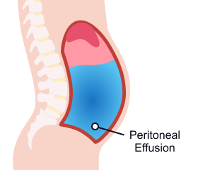 Peritoneal Effusion