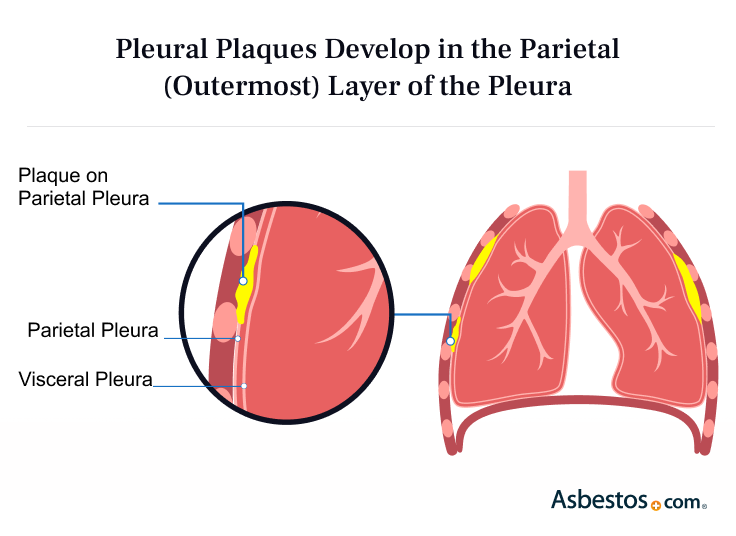 Illustration of Pleural Plaques in the Parietal Layer of the Pleura