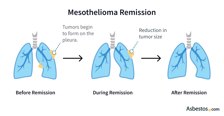 Comparison of lungs to illustrate pleural mesothelioma remission