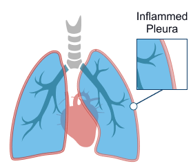 Pleuritis (Inflamed Pleura)