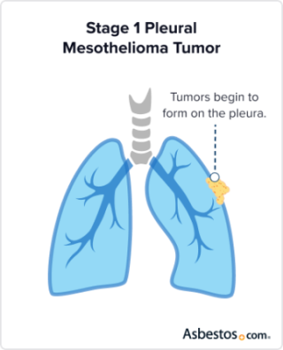 Stage 1 tumor progression